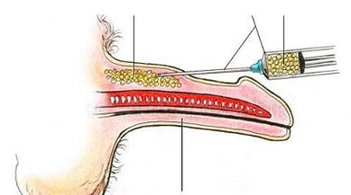 Surgical method to increase the member