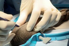 Mosquito incision to surgically enlarge the penis.