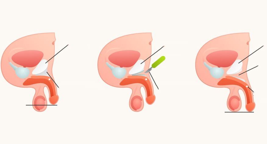 ligamentotomy to enlarge the penis